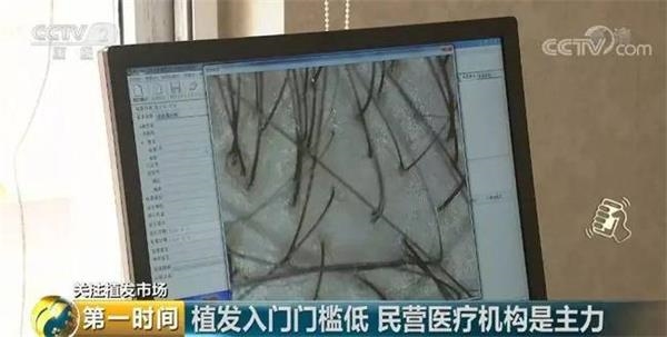 脱发人群超2.5亿