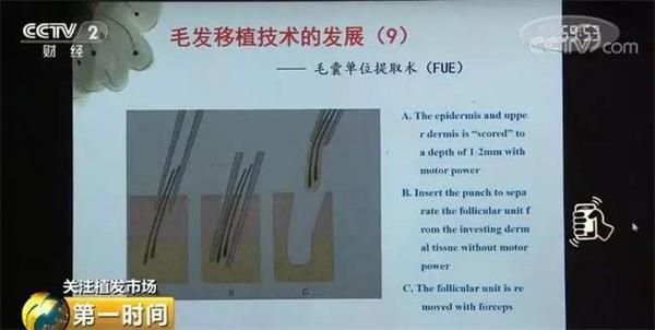 脱发人群超2.5亿